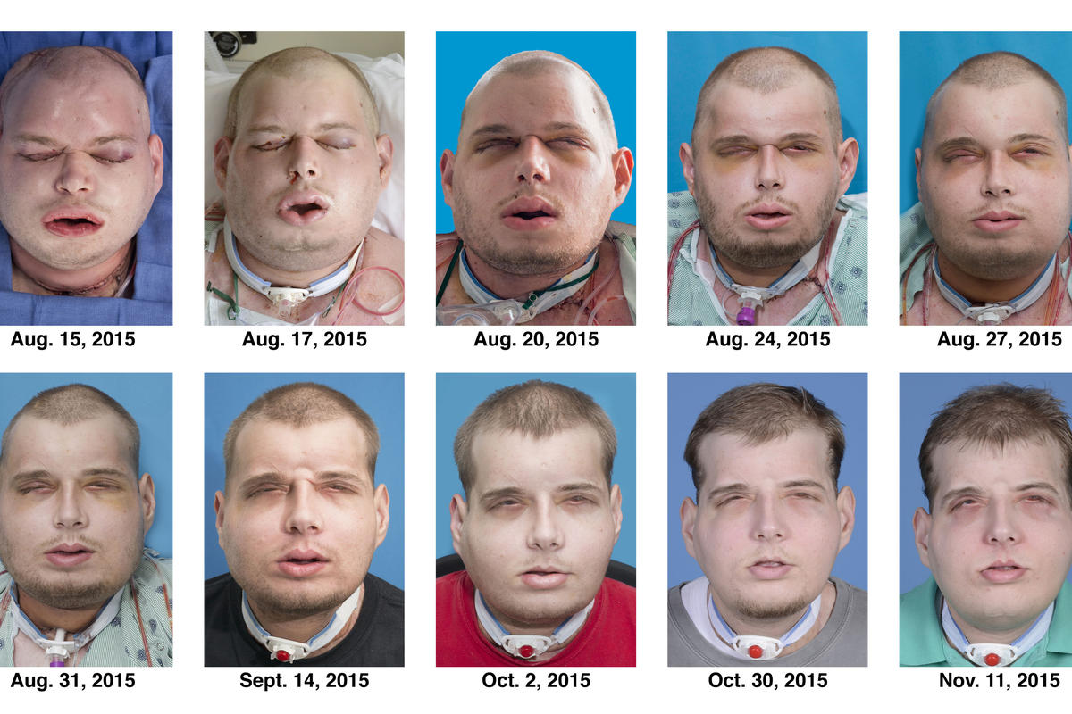 This combination of Aug. 15, 2015 to Nov. 11, 2015 photos provided by the New York University Langone Medical Center shows the recuperation of Patrick Hardison after his facial transplant surgery in New York. Hardison was burned Sept. 5, 2001, in Senatobia, Miss. A 27-year-old father of three at the time who'd served for seven years as a volunteer firefighter, he entered a burning house to search for a woman. The roof collapsed, giving him third-degree burns on his head, neck and upper torso. (Mary Spano/Eduardo D. Rodriguez/Wyss Department of Plastic Surgery/NYU Langone Medical Center via AP)